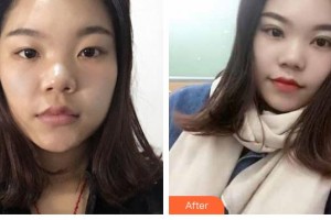 晉中鷹華眼科醫(yī)院蘇國賓整形價格表附切開雙眼皮案例展示