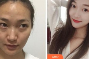 運城市中心醫(yī)院整形外科岳長路整形價格表附激光點痣案例展示