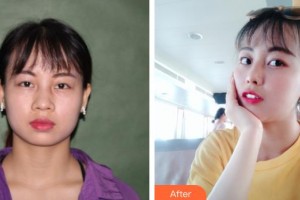 運城光子醫(yī)療美容門診部赫堅整形價格表附鼻部綜合案例展示