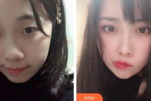 運(yùn)城薛大夫整形美容門診部李彬整形價(jià)格表附眼部綜合案例展示