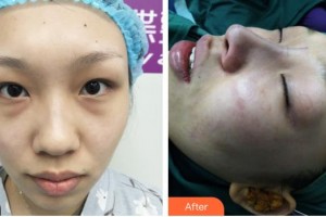 運城華美醫(yī)學(xué)美容醫(yī)院劉安堂整形價格表附耳軟骨復(fù)合隆鼻案例展示