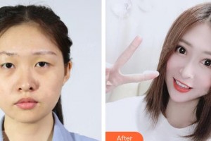 運(yùn)城華美醫(yī)學(xué)美容醫(yī)院布萊恩整形價(jià)格表附假體隆胸案例展示