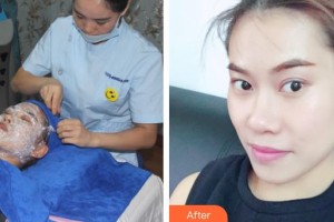 運(yùn)城華美醫(yī)學(xué)美容醫(yī)院李曉麗整形價(jià)格表附清潔祛痘案例展示