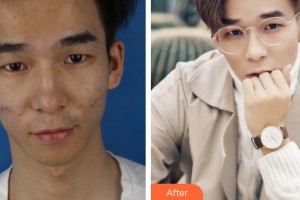 運(yùn)城麗霞醫(yī)療美容診所嚴(yán)麗霞整形價(jià)格表附去痘印痘坑案例展示