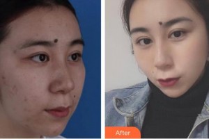 運(yùn)城華美醫(yī)學(xué)美容醫(yī)院劉興芳整形價(jià)格表附清潔祛痘案例展示