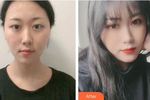 運(yùn)城市中心醫(yī)院整形外科程銀忠整形價(jià)格表附激光祛斑案例展示