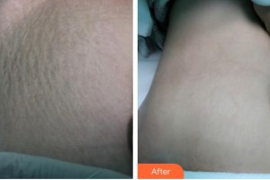 運(yùn)城海鷗美容外科診所暢海鷗整形價(jià)格表附祛妊娠紋案例展示