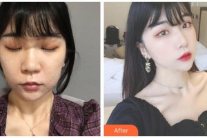 運(yùn)城麗霞醫(yī)療美容診所孫肖陽整形價(jià)格表附去痘印痘坑案例展示