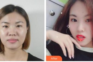 運(yùn)城愛爾眼科醫(yī)院寧英慧整形價(jià)格表附切開雙眼皮案例展示