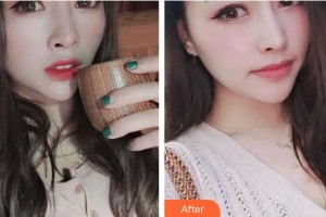 運(yùn)城愛爾眼科醫(yī)院行磊整形價(jià)格表附內(nèi)切祛眼袋案例展示