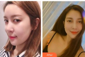 運(yùn)城愛爾眼科醫(yī)院魏潤(rùn)梅整形價(jià)格表附眼部修復(fù)案例展示