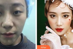 運(yùn)城愛(ài)爾眼科醫(yī)院樊曉娟整形價(jià)格表附切開(kāi)雙眼皮案例展示