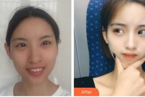 運(yùn)城愛爾眼科醫(yī)院李冬年整形價(jià)格表附眼部綜合案例展示