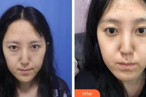 運(yùn)城市眼科醫(yī)院許衛(wèi)玲整形價(jià)格表附切開雙眼皮案例展示