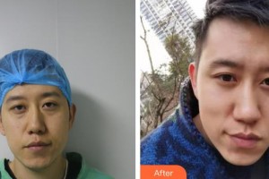 運(yùn)城市眼科醫(yī)院李愛萍整形價(jià)格表附眶隔脂肪釋放案例展示