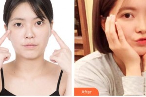 運城愛爾眼科醫(yī)院姜劍整形價格表附開內(nèi)眼角案例展示