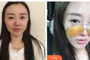 運城市眼科醫(yī)院范雷波整形價格表附眼部綜合案例展示