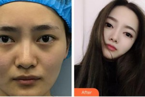 運城市眼科醫(yī)院郭哲峰整形價格表附眼部修復(fù)案例展示