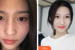 西寧華美整形美容醫(yī)院李靜整形價(jià)格表附皮膚美容案例展示