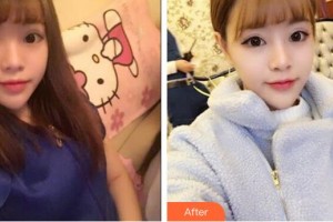 臨汾憶佳星醫(yī)療美容門診部曹玉靜整形價格表附鼻部綜合案例展示