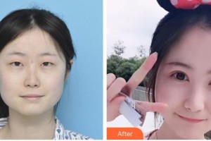 臨汾市堯都區(qū)眼科醫(yī)院張愛當整形價格表附切開雙眼皮案例展示