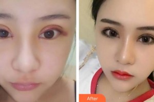 臨汾市堯都區(qū)眼科醫(yī)院趙曉娟住院醫(yī)師整形價格表附切開雙眼皮案例展示