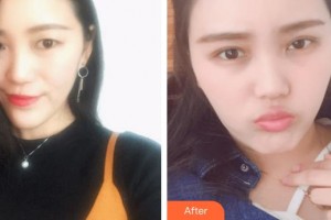 臨汾市堯都區(qū)眼科醫(yī)院鄧明輝整形價格表附眼部綜合案例展示