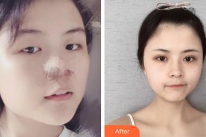 臨汾麗都整形美容門診部李翔宇整形價格表附切開雙眼皮案例展示