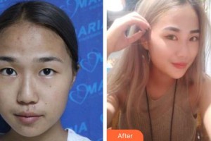 臨汾市堯都區(qū)眼科醫(yī)院馮珍整形價格表附切開雙眼皮案例展示