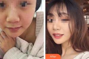 臨汾堯都恒信齒科診所范亞偉整形價格表附隱形托槽矯正案例展示