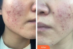 臨汾麗都整形美容門診部姚天飛整形價格表附微針美膚案例展示