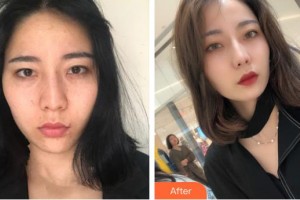 臨汾佳美醫(yī)療整形醫(yī)院劉丹整形價格表附白瓷娃娃案例展示