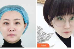 臨汾佳美醫(yī)療整形醫(yī)院韓江立整形價格表附激光祛斑案例展示