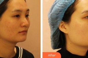 內(nèi)蒙古醫(yī)科大學(xué)附屬醫(yī)院整形美容燒傷科孔懷川整形價(jià)格表附紅藍(lán)光祛痘案例展示