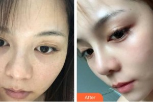 內(nèi)蒙古慕顏醫(yī)療美容門診部劉丹丹整形價(jià)格表附激光祛斑案例展示