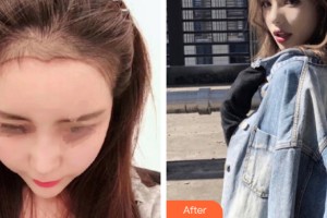 南昌宏昌醫(yī)院毛發(fā)種植中心梁愛峰整形價格表附植發(fā)案例展示