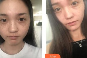 呼和浩特京華醫(yī)療美容診所溫麗霞整形價(jià)格表附激光祛斑案例展示