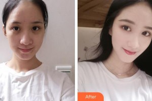 呼和浩特伊思整形?？漆t(yī)院白莉整形價格表附紅藍光祛痘案例展示