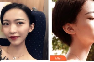 呼和浩特閆小林醫(yī)療美容門診部王月英整形價格表附微針?biāo)饫故?>
</a>
<h3 class=