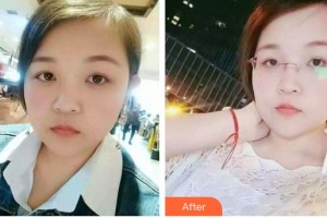 呼和浩特五洲女子醫(yī)院整形美容中心王煥整形價格表附激光祛斑案例展示