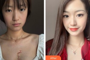 呼和浩特任榮大韓醫(yī)療美容診所閆小宇整形價格表附微創(chuàng)疤痕修復(fù)案例展示