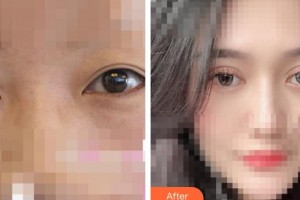 呼和浩特華醫(yī)醫(yī)療美容門診部于霞整形價格表附埋線雙眼皮案例展示