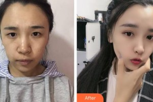 呼和浩特新視界眼科醫(yī)院代永青整形價格表附眼部綜合案例展示