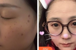 包頭葉子整形美容醫(yī)院馮守運整形價格表附激光祛斑例展示