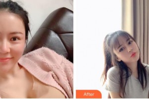 包頭聯(lián)合麗格醫(yī)療美容門診部賀清枝整形價格表附鼻部綜合案例展示