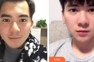 包頭李德皮膚醫(yī)院謝志強整形價格表附白瓷娃娃案例展示