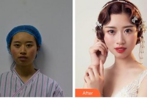 包頭時光醫(yī)療美容門診部常青整形價格表附埋線提升例展示