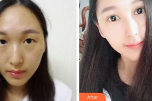 包頭朝聚眼科醫(yī)院邊小燕整形價格表附切開雙眼皮案例展示