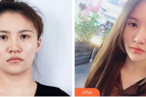 包頭麗人婦產(chǎn)醫(yī)院醫(yī)學美容科李繼偉整形價格表附埋線雙眼皮案例展示