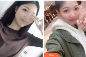 包頭朝聚眼科醫(yī)院周園整形價格表附眼部綜合例展示